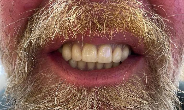 Dentures-After-Image