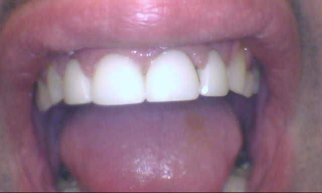 Esthetic-Crowns-After-Image