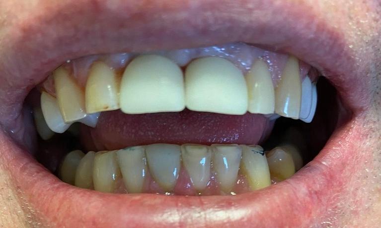 Immediate-Implant-Restoration-After-Image
