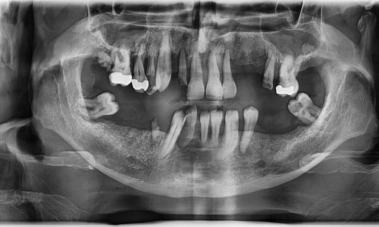 Dentures-Before-Image