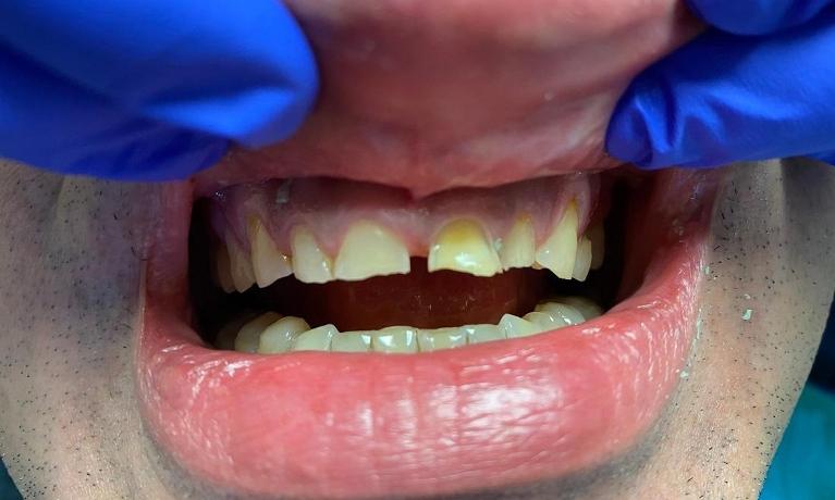 Esthetic-Crowns-Before-Image