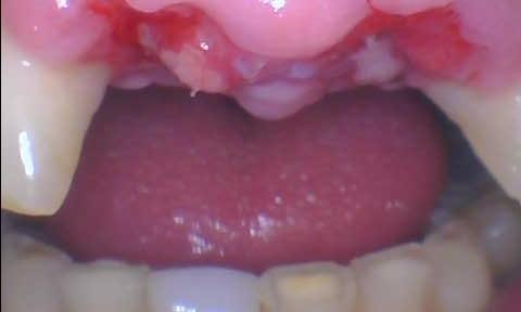 Immediate-Implant-Restoration-Before-Image