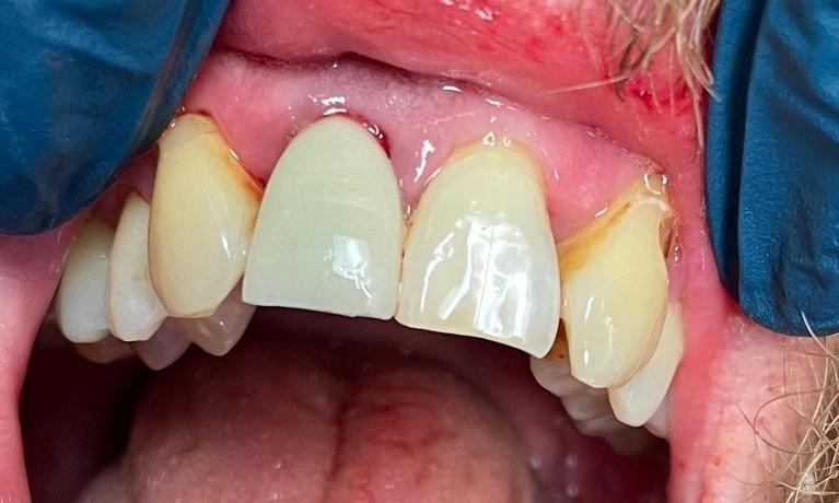 Immediate-Implants-After-Image