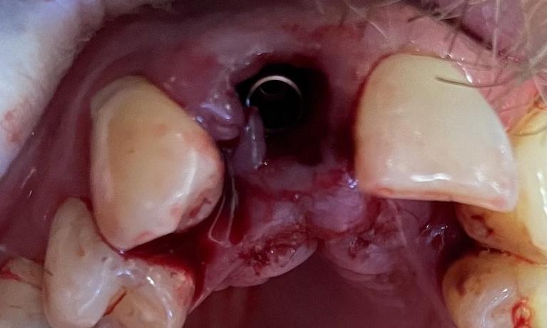 Immediate-Implants-Before-Image